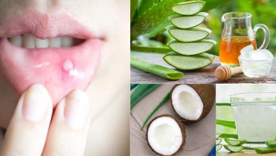 Remedies for Mouth Ulcers If you want to get rid of mouth ulcers, then these cheap home remedies will cure you at home