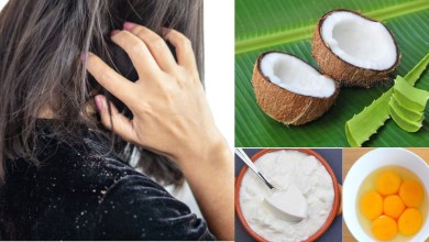 Dandruff Treatment If you are troubled by the problem of dandruff in your hair, then your hair with dandruff will end in just 10 rupees, follow these home remedies