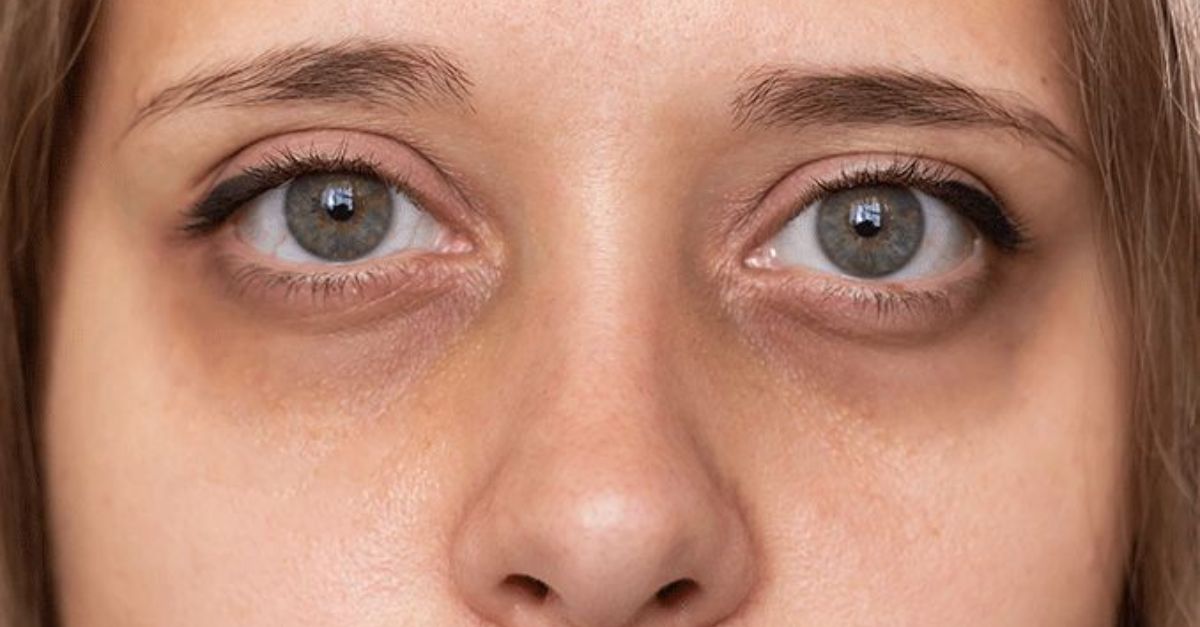 Dark Circles Troubled by the dark circles happening under the eyes, so be careful immediately, this can be a big reason