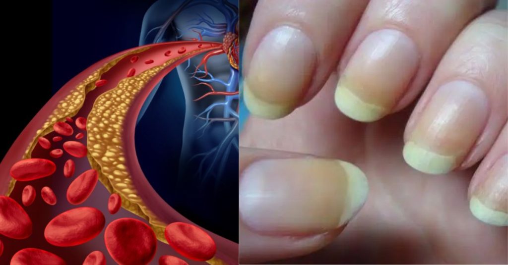 High Cholesterol These important symptoms appear in the nails when cholesterol increases, do not ignore even by mistake