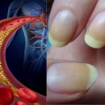High Cholesterol These important symptoms appear in the nails when cholesterol increases, do not ignore even by mistake