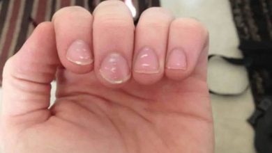 White Spots on Nails Are there white marks in the nails So be careful immediately, this could be the reason