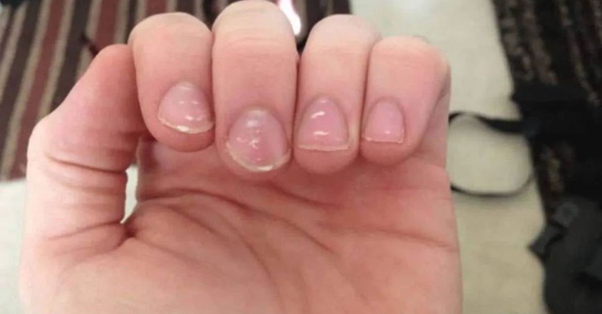 White Spots on Nails Are there white marks in the nails So be careful immediately, this could be the reason