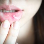Home Remedies Are you troubled by the problem of mouth ulcers So follow these home remedies to get rid of them