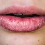 Home Remedies if Chapped Lips look rough, so apply these things to soften your lips