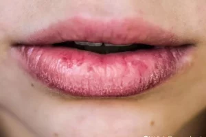 Home Remedies if Chapped Lips look rough, so apply these things to soften your lips